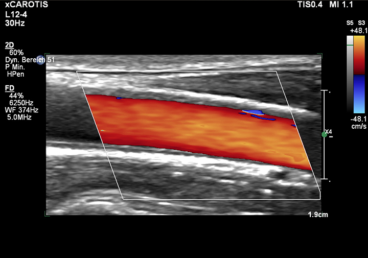 Priv.-Doz. Dr. med. Gabriele Demetz. Farbduplexuntersuchung von Arterien